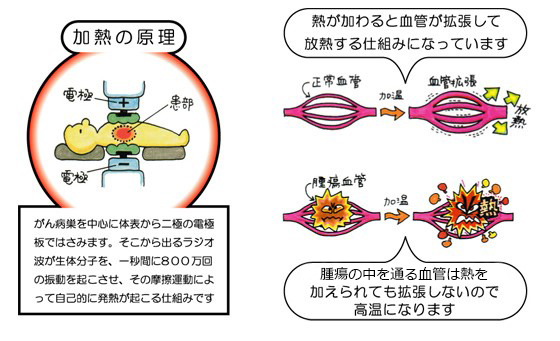 温熱療法による加温の原理